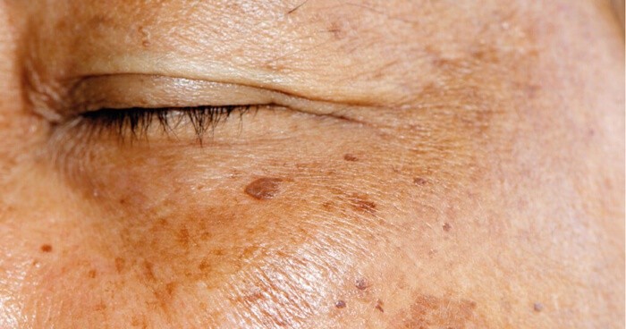 a-guide-to-skin-pigmentation-01-01-1024×538 | Aloe Ferox Skin Products