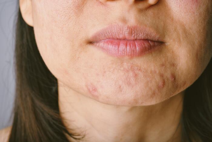skin purging blog
