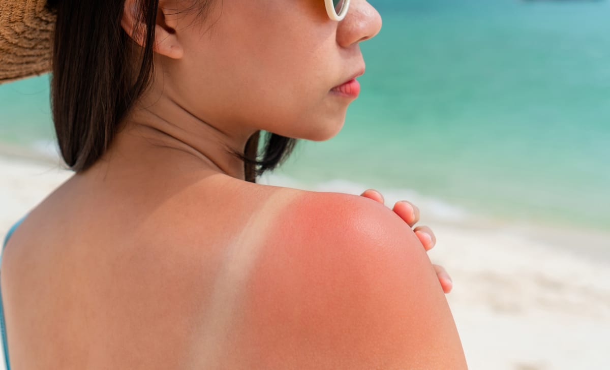 Sunburn—How-To-Recog